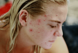  plant-based protein cause acne